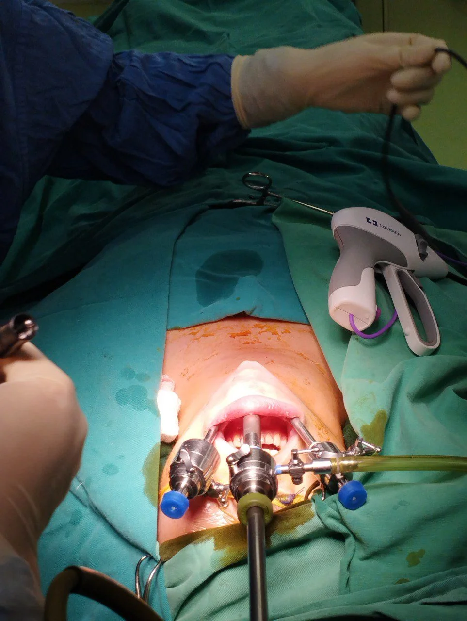 Vị trí đặt trocart trong phẫu thuật nội soi tuyến giáp qua đường miệng
