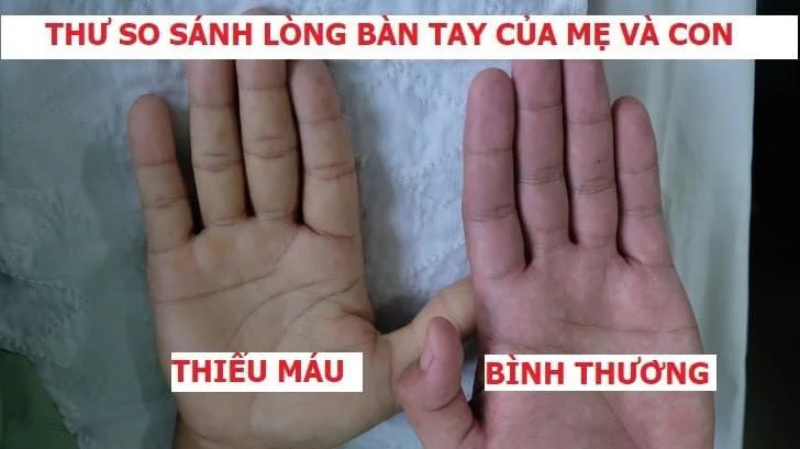 Hình 1: Hình ảnh so sánh lòng bàn tay giữa người thiếu máu và người bình thường