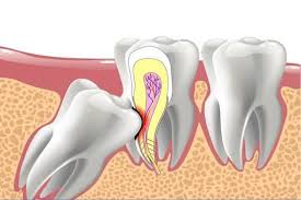Dấu hiệu điển hình của răng khôn mọc lệch nguy cơ dẫn đén áp xe vùng hàm mặt