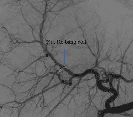Hình ảnh sau nút mạch cầm máu vỡ gan bằng vật liệu (vòng xoắn kim loại - coil)