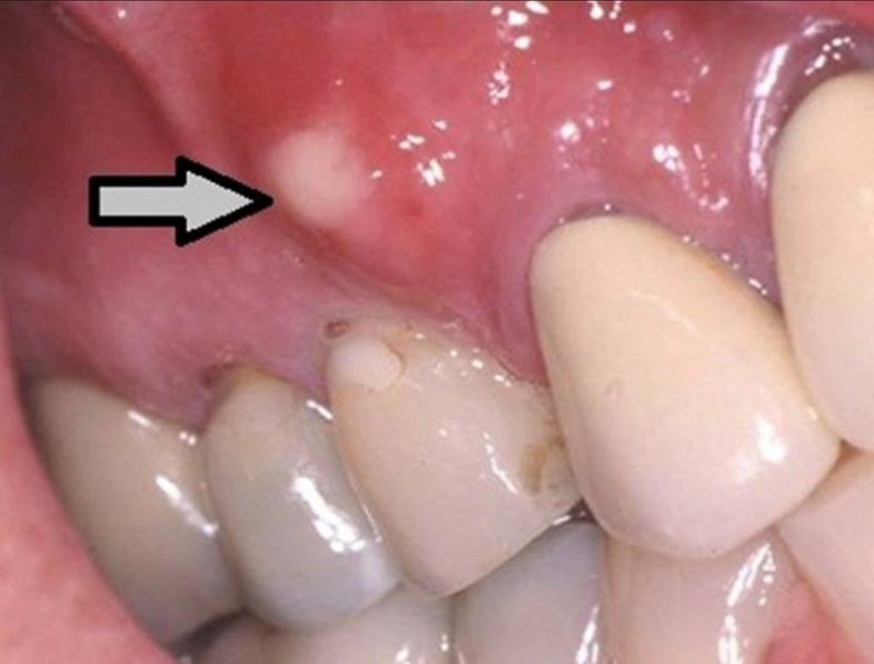 Hình ảnh bệnh nhân bị áp xe quanh răng