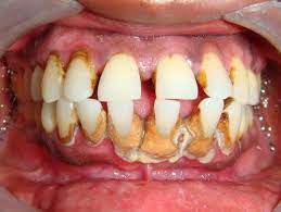 Biến chứng viêm quanh răng là tiêu xương ổ răng