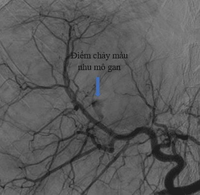 Cầm máu vỡ gan diện rộng chỉ bằng 1 thủ thuật can thiệp xâm lấn tối thiểu 2 Hình ảnh chụp mạch xác định điểm chảy máu của bệnh nhân vỡ gantrước khi nút mạch (Cầm máu gan)