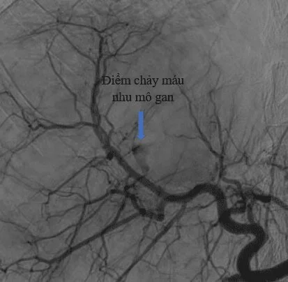 Hình ảnh chụp mạch xác định điểm chảy máu của bệnh nhân vỡ gantrước khi nút mạch (Cầm máu gan)