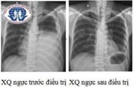 sinh thiết màng phổi