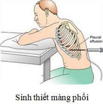 sinh thiết màng phổi