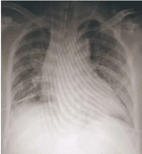 Hình ảnh Xquang phổi của người bệnh cải thiện sau 5 ngày đặt ECMO