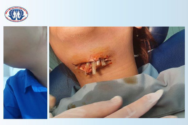 Hình ảnh trước sưng tấy và sau phẫu thuật của người bệnh bị áp xe vùng góc hàm mặt
