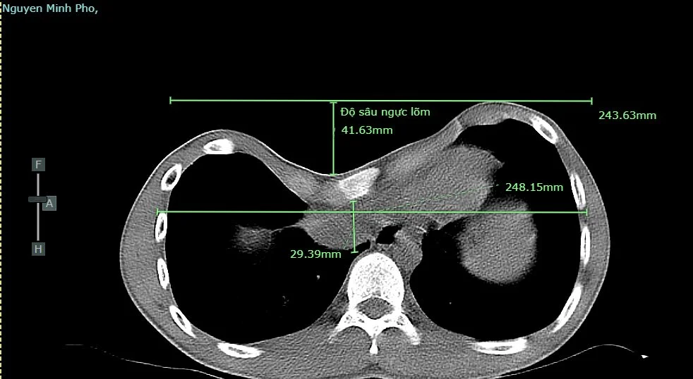 Hình ảnh lõm lồng ngực của người bệnh qua chụp CT
