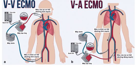 Phương pháp oxy hóa qua màng ngoài cơ thể được sử dụng như thế nào trong ECMO?
