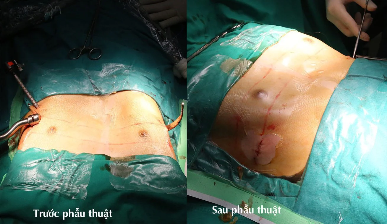 Hình ảnh ngực người bệnh trước và sau phẫu thuật