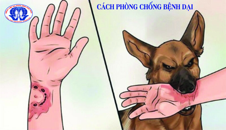 Triệu chứng triệu chứng dại và cách phòng ngừa