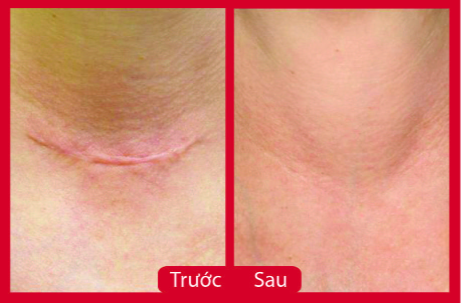 Hình ảnh trước và sau khi điều trị sẹo lồi