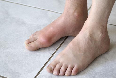 Không đi chân trần (chân không) là cách chăm sóc bàn chân tiểu đường tốt 