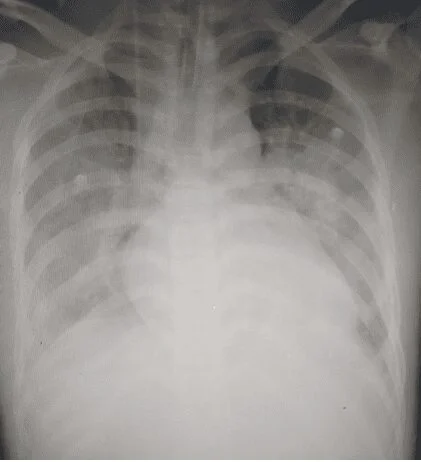 Hình ảnh tổn thương phổi của người bệnh trước khi đặt ECMO
