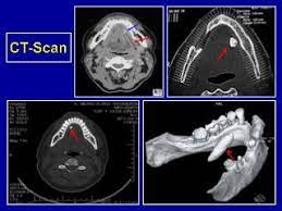 Hình ảnh chụp CT bệnh nhân có sỏi tuyến nước bọt