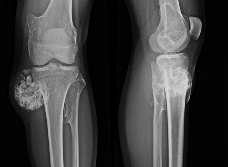 Hình ảnh chụp X-quang U xương sụn 02