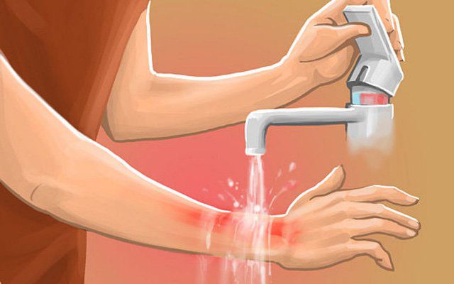 Sơ cứu bỏng nhiệt: Nhanh chóng ngâm rửa vùng cơ thể bị bỏng vào nước sạch