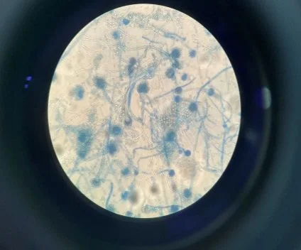 nấm phổi Aspergillus