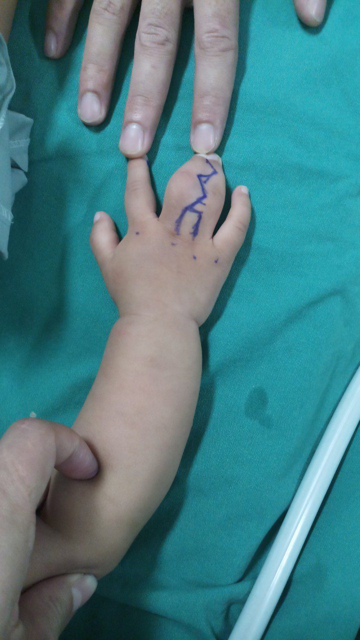 Bàn tay trẻ bị dị tật dính ngón tay bẩm sinh trước phẫu thuật