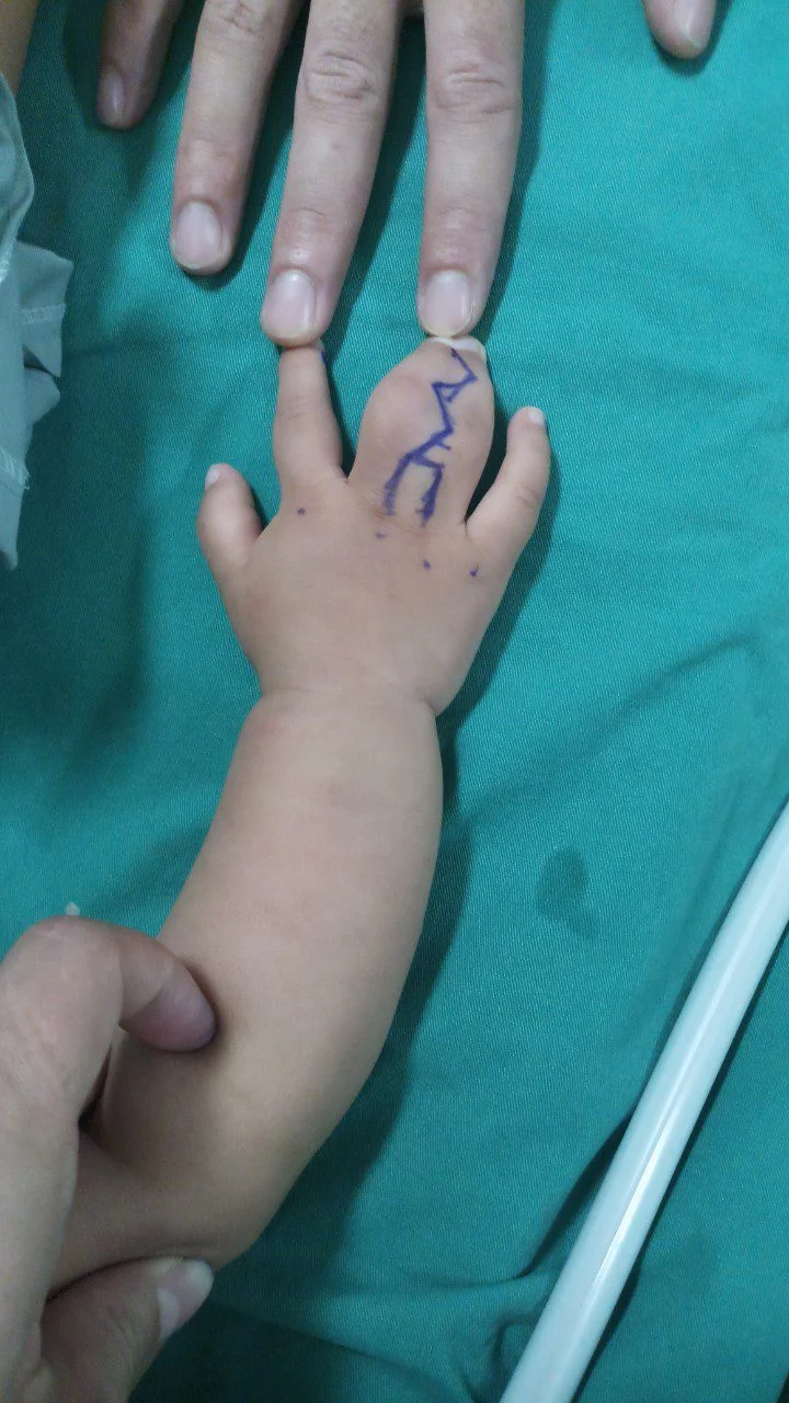 Bàn tay trẻ bị dị tật dính ngón tay bẩm sinh trước phẫu thuật