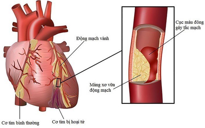 Bệnh động mạch vành nguyên nhân gây tử vong số 1 trong các bệnh tim mạch