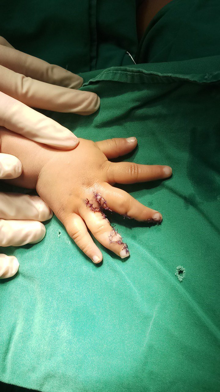 Bàn tay trẻ bị dị tật dính ngón tay bẩm sinh sau phẫu thuật