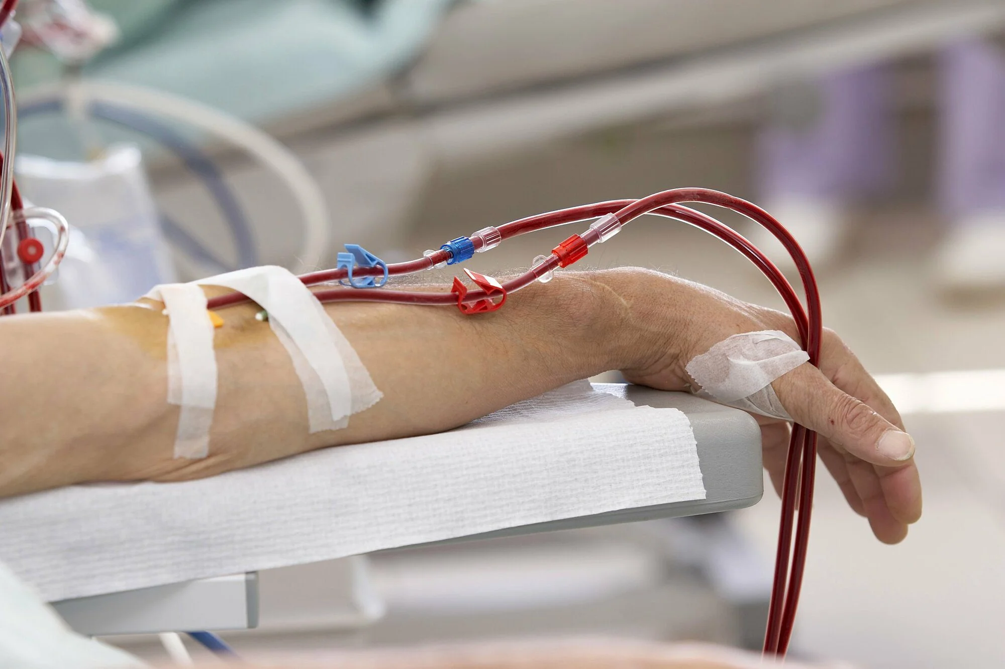 Kỹ thuật thẩm tách siêu lọc máu – Giải pháp tối ưu cho người suy thận mạn giai đoạn cuối