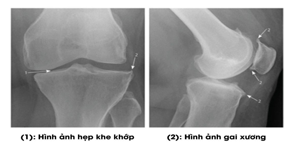 Thoái hóa khớp gối