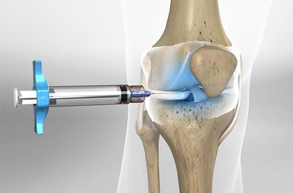 Thoái hóa khớp gối