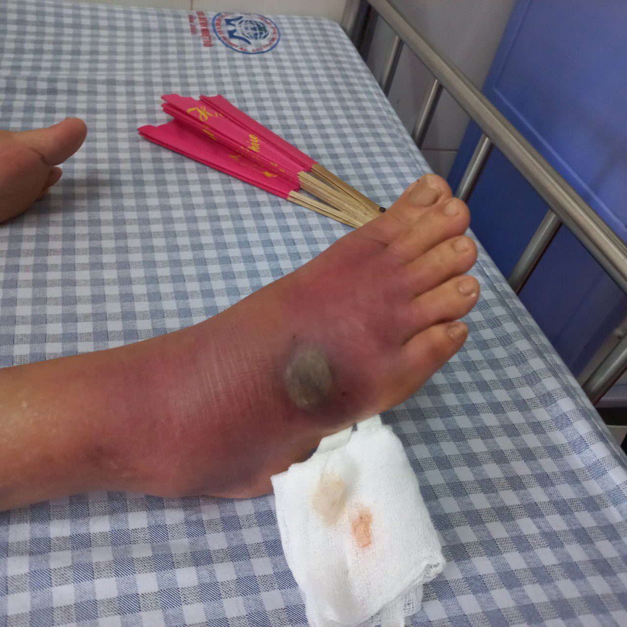 Hình ảnh khi người bệnh vào viện sưng tấy lan tỏa toàn bộ mu chân lên cổ chân, tại trung tâm vết cắn đang có dấu hiệu hoại tử ướt