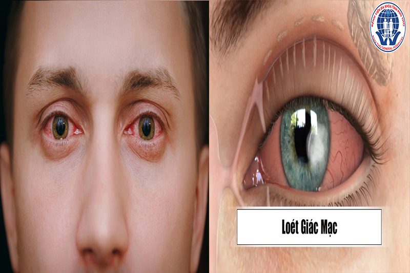 Đau mắt đỏ có thể gây viêm giác mạc, hoặc nặng hơn loét giác mạc dẫn đến mù lòa