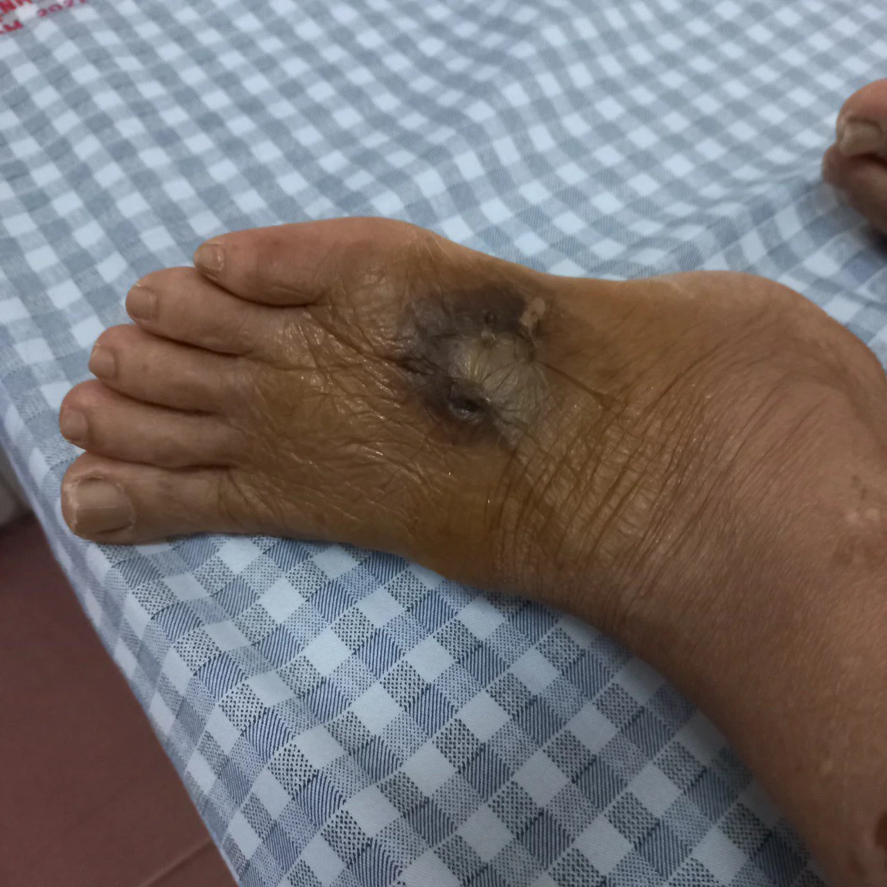 Nguy hiểm khi chuột cắn - 1 bệnh nhân hoại tử ướt bàn chân