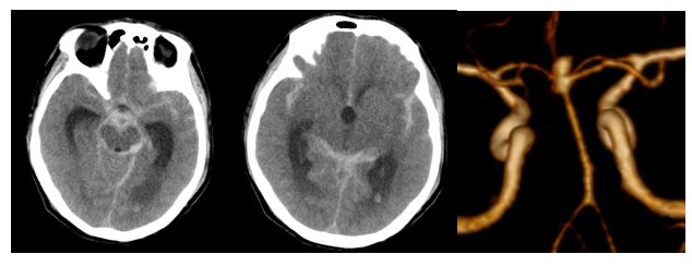 Hình 1: Hình ảnh chụp sọ não bệnh nhân phình mạch máu não thời điểm nhập viện