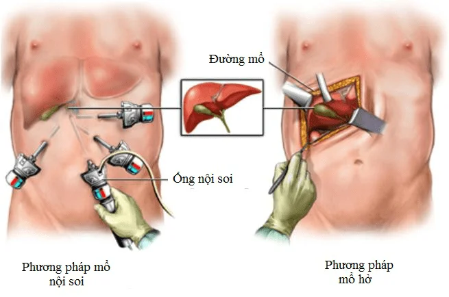 Phẫu thuật nội soi cắt túi mật so với phẫu thuật mở