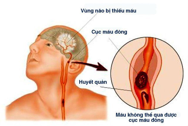 Thuốc tiêu sợi huyết sử dụng trong trường hợp nhồi máu não
