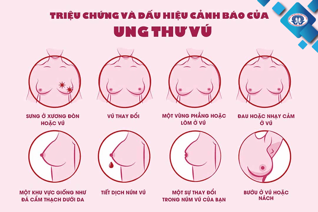 Triệu chứng và dấu hiệu nhận biết của ung thư vú