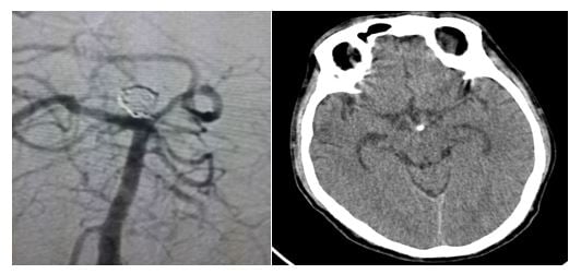 Hình 2: Hình ảnh chụp sọ não bệnh nhân sau can thiệp và lúc ra viện