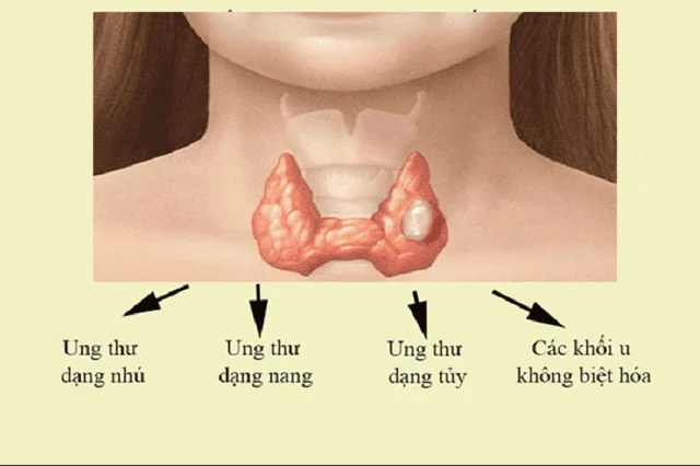 Carcinoma tuyến giáp dạng nhú là gì? Tìm hiểu về nguyên nhân, triệu chứng và phương pháp điều trị