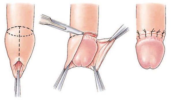 Cắt bao quy đầu – 1 số thông tin cần biết