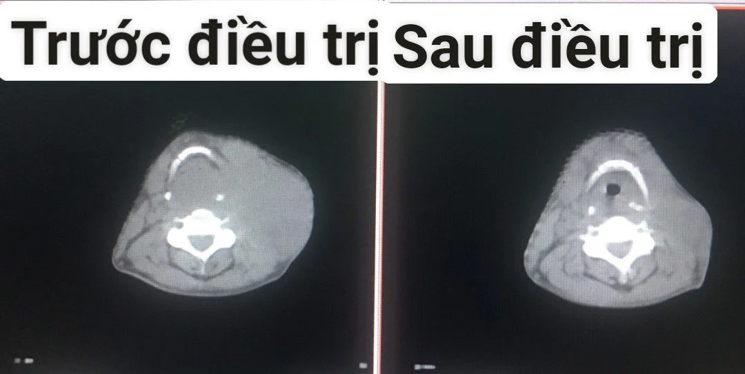 Hình ảnh chụp CT cho thấy tổn thương đáp ứng rất tốt với phác đồ điều trị