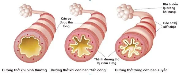 Hình 1: Tổn thương viêm phổi dạng nốt do dùng amiodaron