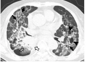 Hình 2: Tổn thương xơ phổi do dùng genfinitib ở bệnh nhân ung thư phổi