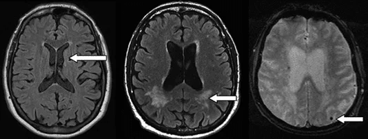Nhồi máu não thầm lặng (trái), tăng tín hiệu chất trắng (giữa) và chảy máu não vi thể (phải) trên hình ảnh MRI não