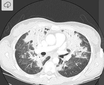 Tổn thương phổi do thuốc 3 Hình 3: Tổn thương phổi đông đặc do dùng pembrolizumab