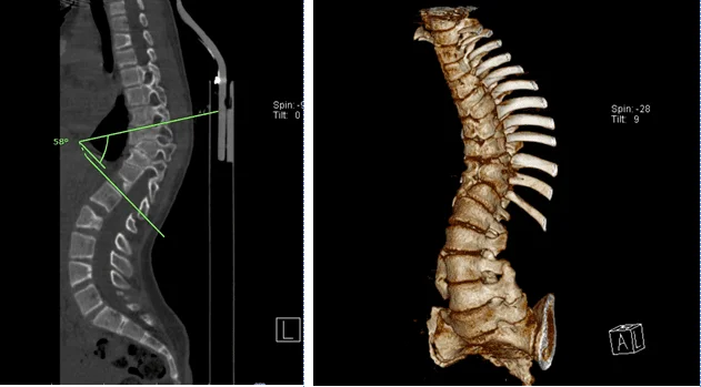 Hình 1: Hình chụp CT 3D dựng hình cột sống