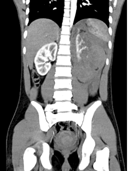 Hình ảnh chụp CT ổ bụng cho thấy chấn thương vỡ hoàn toàn thận trái.