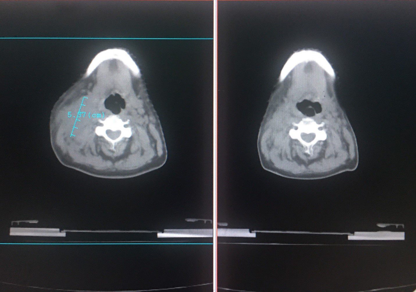 Hình ảnh so sánh trước và sau điều trị tại cùng vị trí khi quan sát hình ảnh qua chụp CLVT hàm – mặt của bệnh nhân Ung thư vòm tái phát