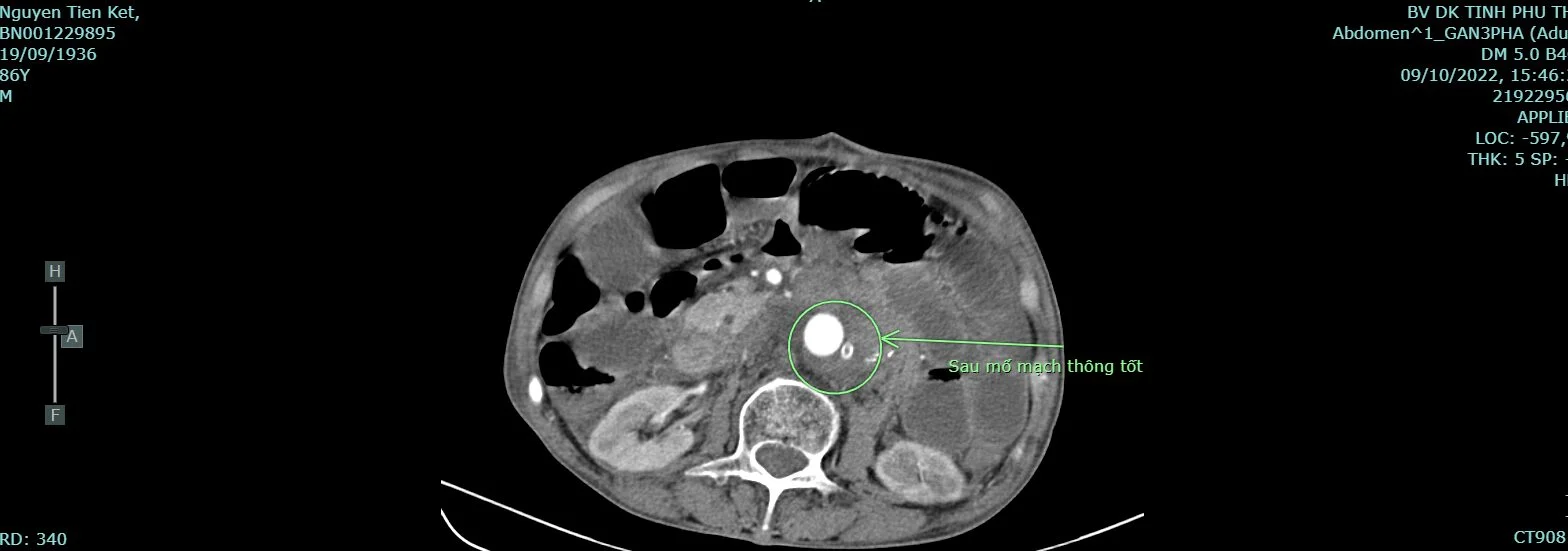 Hình ảnh chụp cắt lớp vi tính của người bệnh sau phẫu thuật vỡ phình động mạch chủ bụng