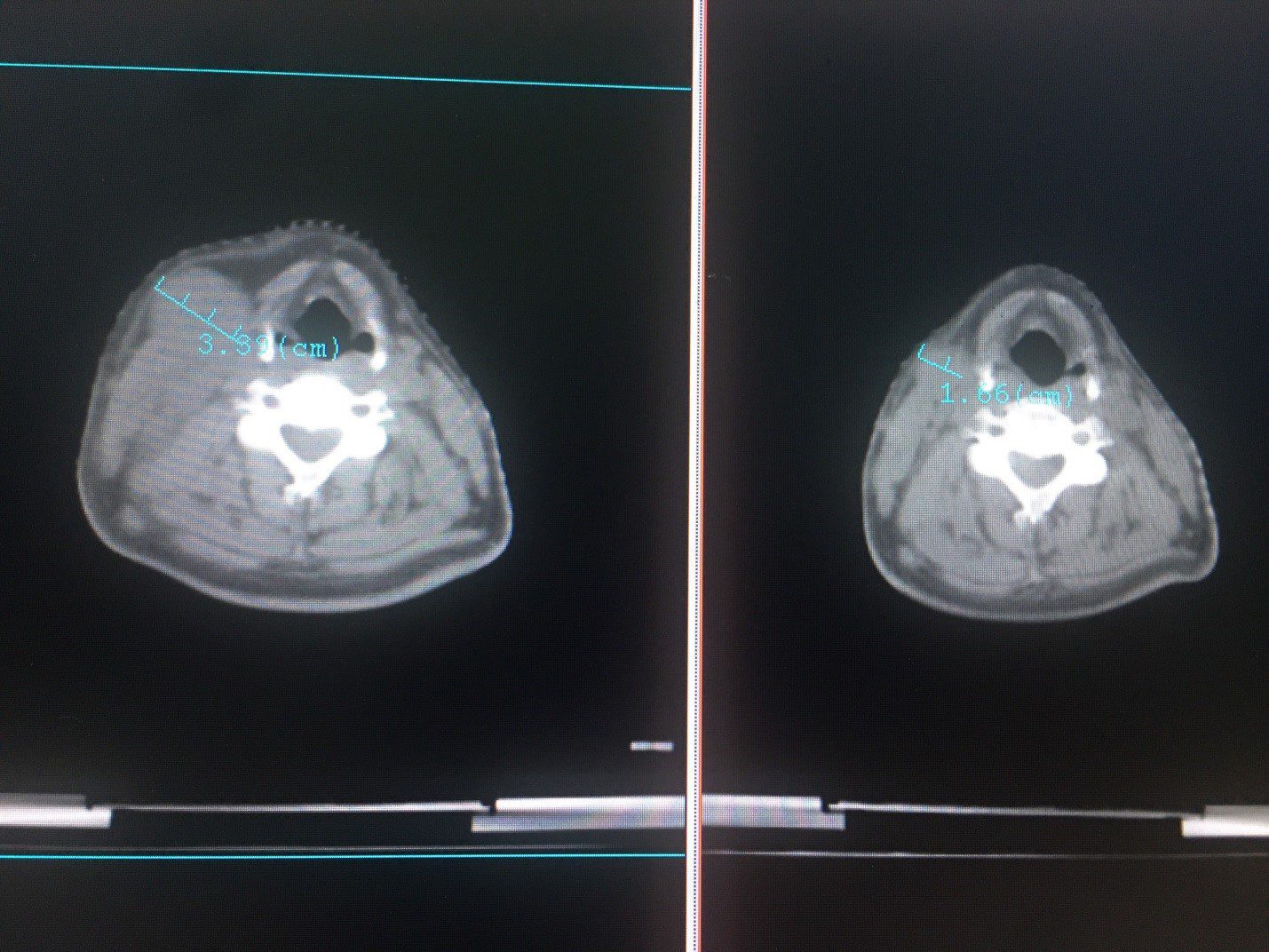 Hình ảnh so sánh trước và sau điều trị tại cùng vị trí khác của bệnh nhân Ung thư vòm tái phát